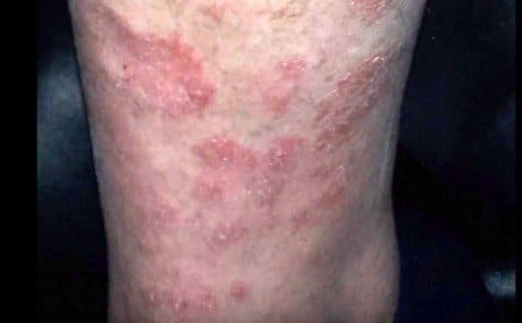 Éruption de psoriasis sur le tibia