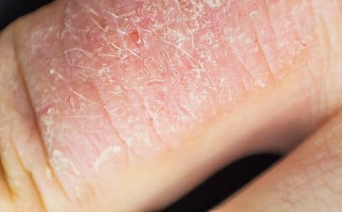 Éruption de psoriasis sur les jointures